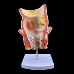 Anatomical Human Rectum Pathology Lesion Model Hemorrhoids Anus Teaching Supply
