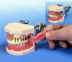 Dental Periodontal Hygiene Diseases Model Calculus Deposit Bone Gum Loss Patholo