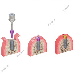 Dental Straumann Healing Abutments Closure Cover Screws NC/RC Fit ITI