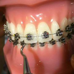 AZDENT Dental Ortho Brackets Brace Self-Ligating Active Mini Roth 022 Hooks 345