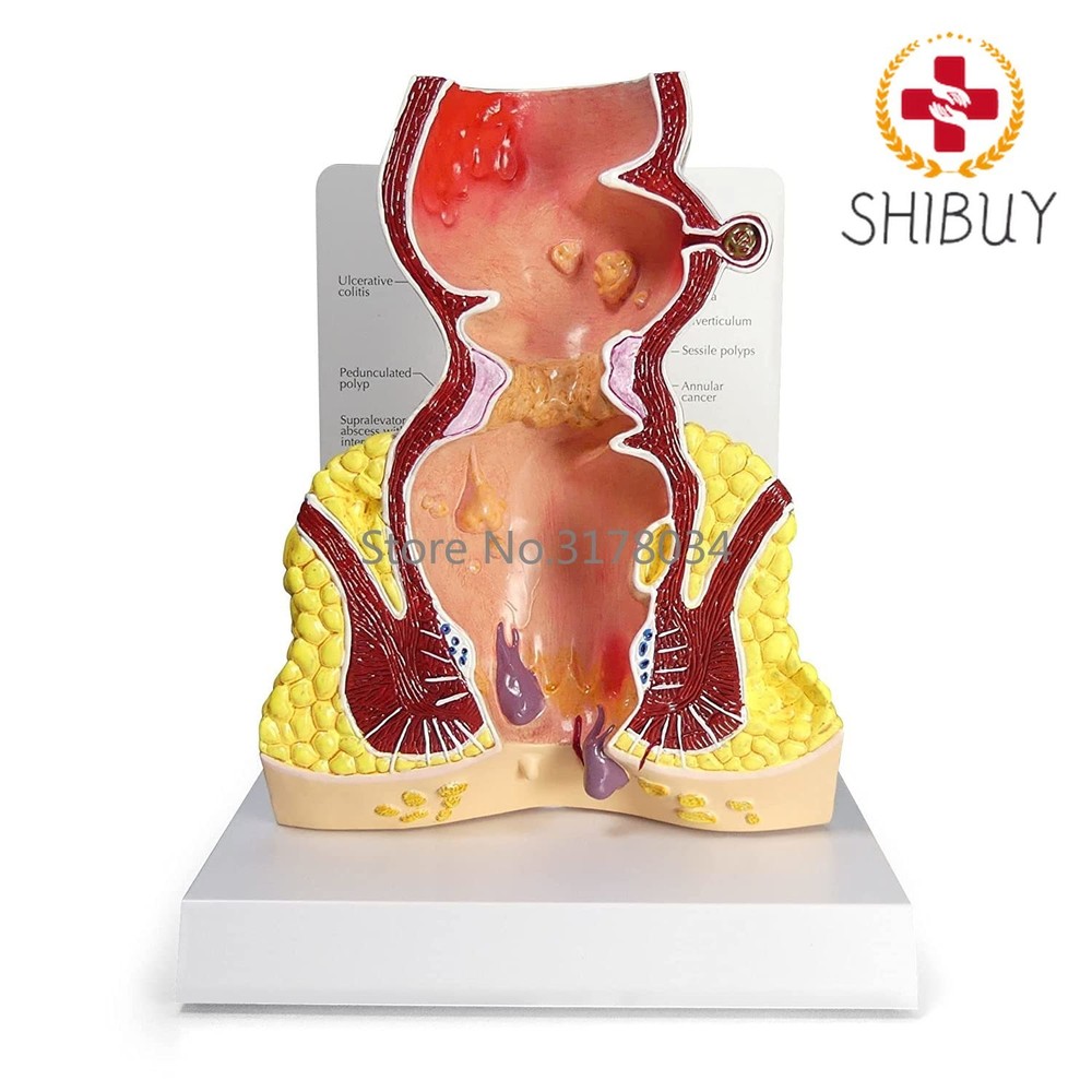 Rectum Model Human Body Anatomy Replica of Rectum W/Common Pathologies Model