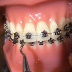 AZDENT Dental Ortho Brackets Brace Self-Ligating Active Mini Roth 022 Hooks 345