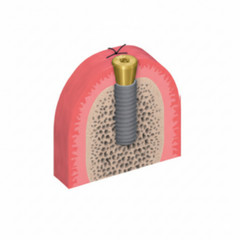 ITI Dental Abutment Healing Locator Transfer Scanbody Analog for Straumann NC/RC